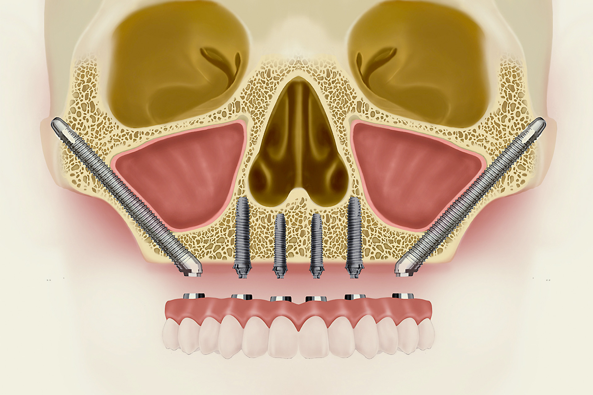 Implantes Zigomáticos - Centro Dental Dra. Mayte Montesinos - Dentistas en Pilar de la Horadada, Alicante