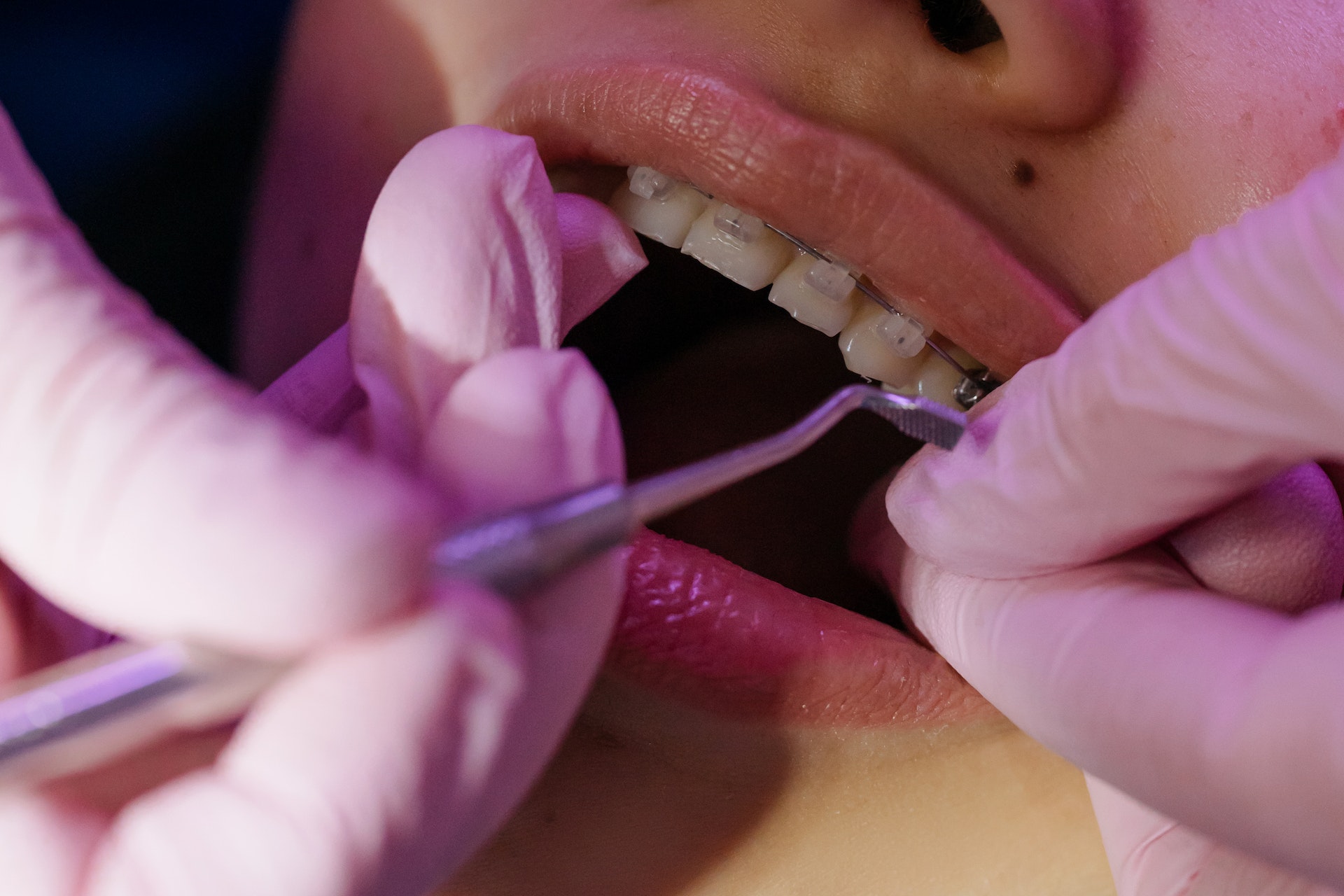 Ortodoncia tradicional - Centro Dental Dra. Mayte Montesinos - Dentistas en Pilar de la Horadada, Alicante