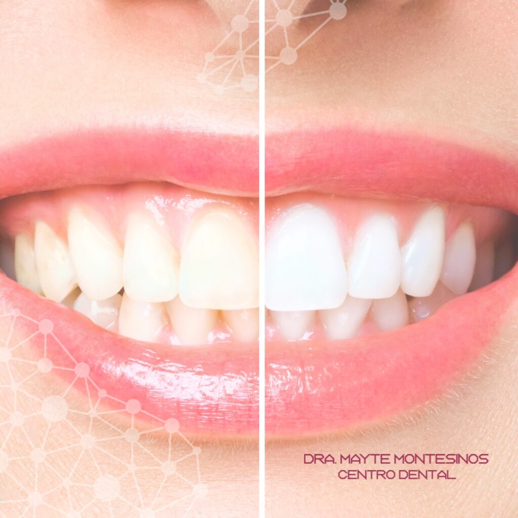 Blog-Noviembre - Centro Dental Dra. Mayte Montesinos - Dentistas en Pilar de la Horadada, Alicante